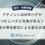 アデノシンはM字ハゲやつむじハゲに効果がある？男性の薄毛部位による変化の目安