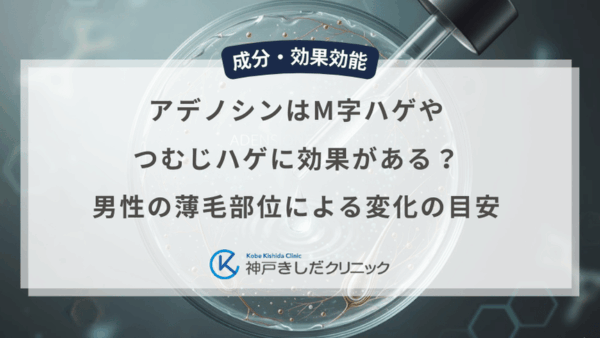 アデノシンはM字ハゲやつむじハゲに効果がある？男性の薄毛部位による変化の目安