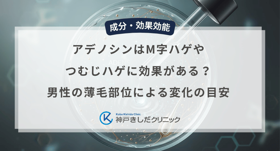 アデノシンはM字ハゲやつむじハゲに効果がある？男性の薄毛部位による変化の目安