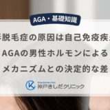 円形脱毛症の原因は自己免疫疾患？AGAの男性ホルモンによるメカニズムとの決定的な差