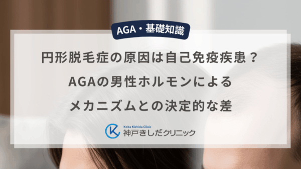円形脱毛症の原因は自己免疫疾患？AGAの男性ホルモンによるメカニズムとの決定的な差