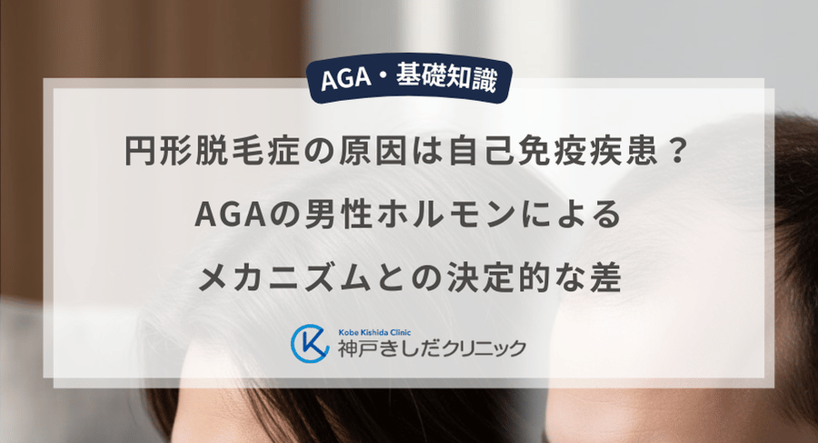 円形脱毛症の原因は自己免疫疾患?AGAの男性ホルモンによるメカニズムとの決定的な差