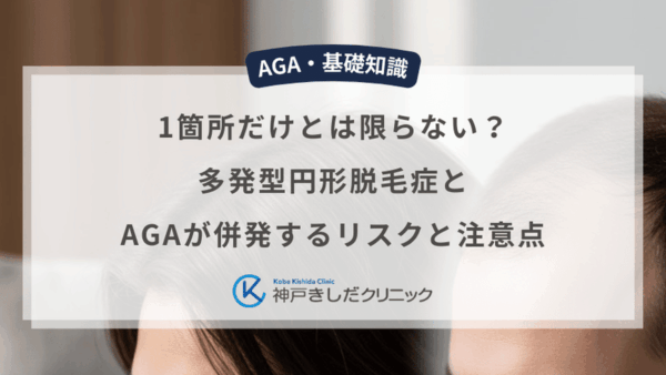 1箇所だけとは限らない？多発型円形脱毛症とAGAが併発するリスクと注意点