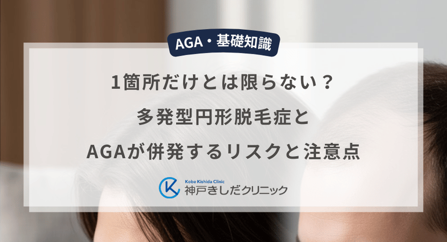 1箇所だけとは限らない?多発型円形脱毛症とAGAが併発するリスクと注意点