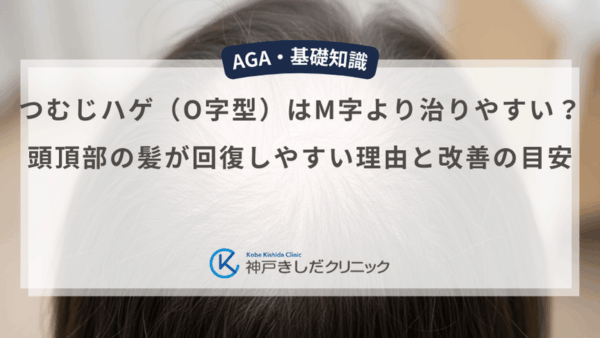 つむじハゲ（O字型）はM字より治りやすい？頭頂部の髪が回復しやすい理由と改善の目安