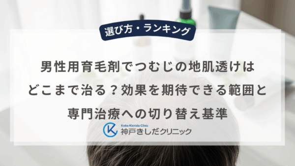 男性用育毛剤でつむじの地肌透けはどこまで治る？効果を期待できる範囲と専門治療への切り替え基準
