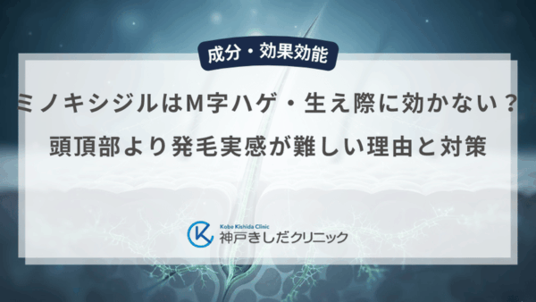 ミノキシジルはM字ハゲ・生え際に効かない？頭頂部より発毛実感が難しい理由と対策