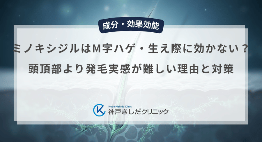 ミノキシジルはM字ハゲ・生え際に効かない?頭頂部より発毛実感が難しい理由と対策