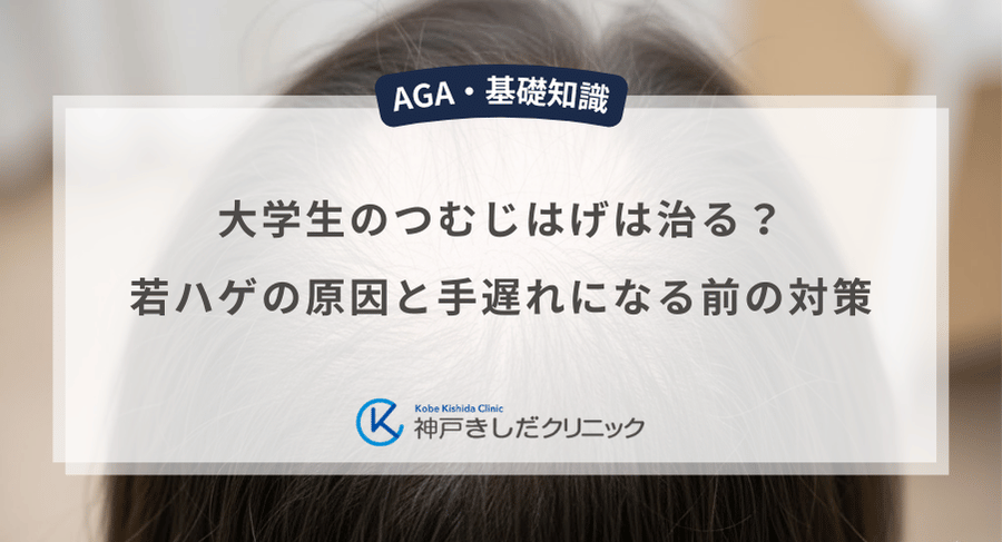 大学生のつむじはげは治る？若ハゲの原因と手遅れになる前の対策