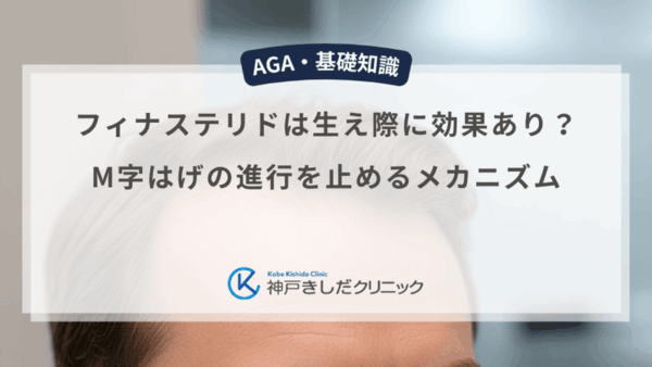 フィナステリドは生え際に効果あり？M字はげの進行を止めるメカニズム