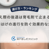 生え際の後退は育毛剤で止まる？M字はげの進行を防ぐ効果的な対策