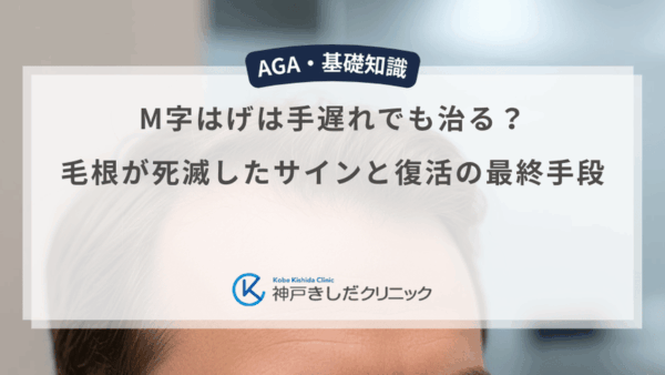 M字はげは手遅れでも治る？毛根が死滅したサインと復活の最終手段