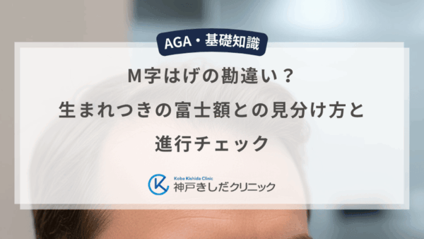 M字はげの勘違い？生まれつきの富士額との見分け方と進行チェック