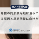 男性の円形脱毛症は治る？発症する原因と早期回復に向けた治療法