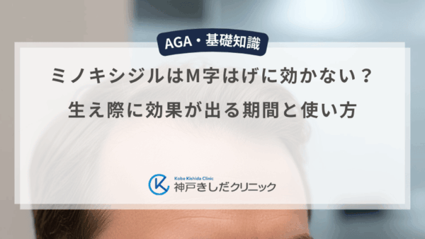 ミノキシジルはM字はげに効かない？生え際に効果が出る期間と使い方