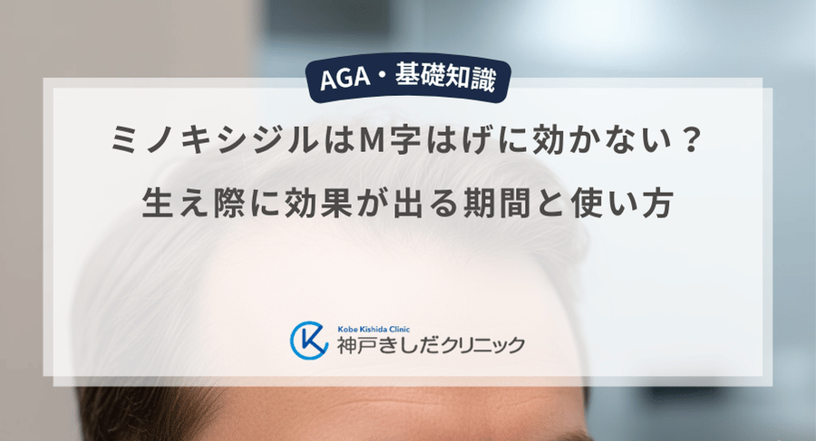 ミノキシジルはM字はげに効かない？生え際に効果が出る期間と使い方