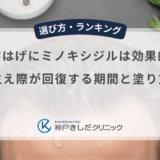 M字はげにミノキシジルは効果的？生え際が回復する期間と塗り方