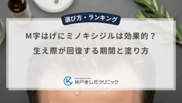 M字はげにミノキシジルは効果的？生え際が回復する期間と塗り方