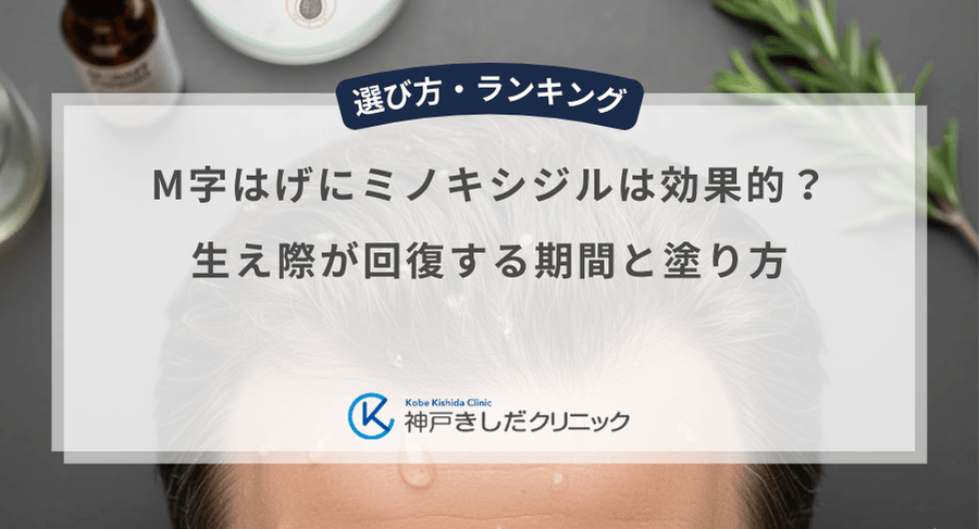 M字はげにミノキシジルは効果的？生え際が回復する期間と塗り方