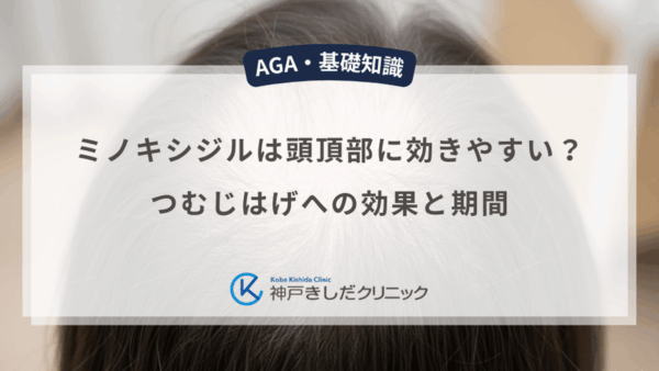 ミノキシジルは頭頂部に効きやすい？つむじはげへの効果と期間