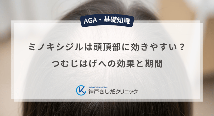 ミノキシジルは頭頂部に効きやすい?つむじはげへの効果と期間