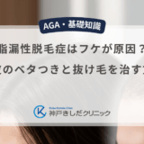 脂漏性脱毛症はフケが原因？頭皮のベタつきと抜け毛を治す方法