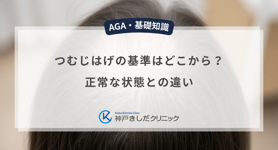 つむじはげの基準はどこから？正常な状態との違い