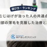 つむじはげが治った人の共通点！頭頂部の薄毛を克服した治療と期間