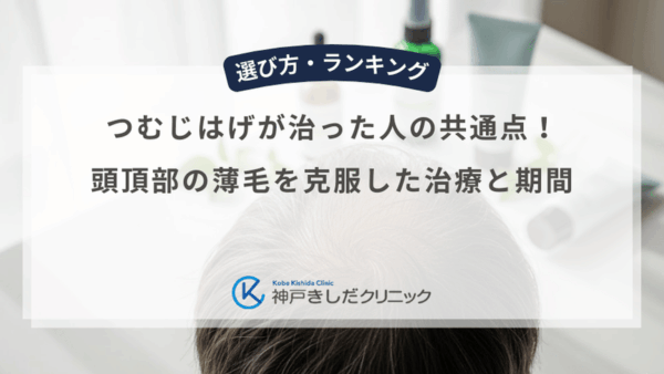 つむじはげが治った人の共通点！頭頂部の薄毛を克服した治療と期間