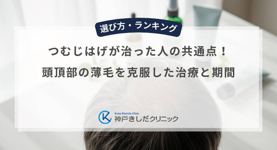 つむじはげが治った人の共通点！頭頂部の薄毛を克服した治療と期間