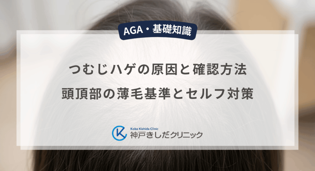 つむじハゲの原因と確認方法｜頭頂部の薄毛（O字型）基準とセルフ対策