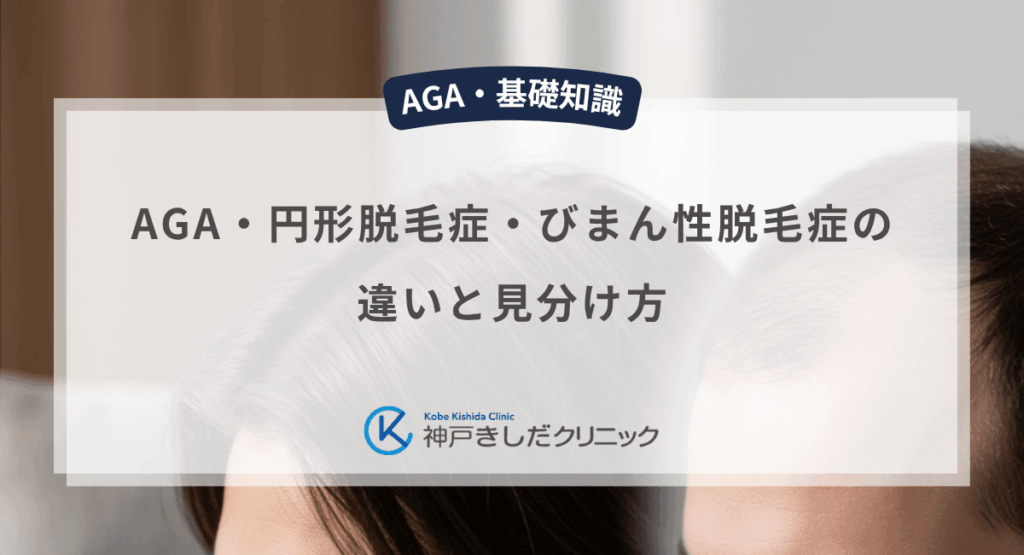 AGA・円形脱毛症・びまん性脱毛症の違いと見分け方