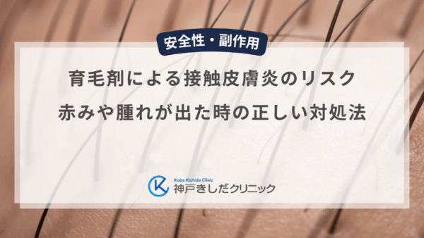 育毛剤による接触皮膚炎のリスク｜赤みや腫れが出た時の正しい対処法