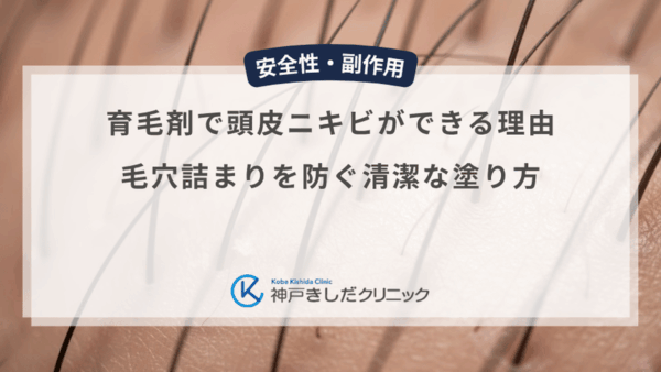 育毛剤で頭皮ニキビができる理由｜毛穴詰まりを防ぐ清潔な塗り方