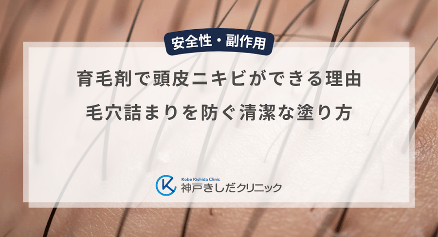 育毛剤で頭皮ニキビができる理由|毛穴詰まりを防ぐ清潔な塗り方