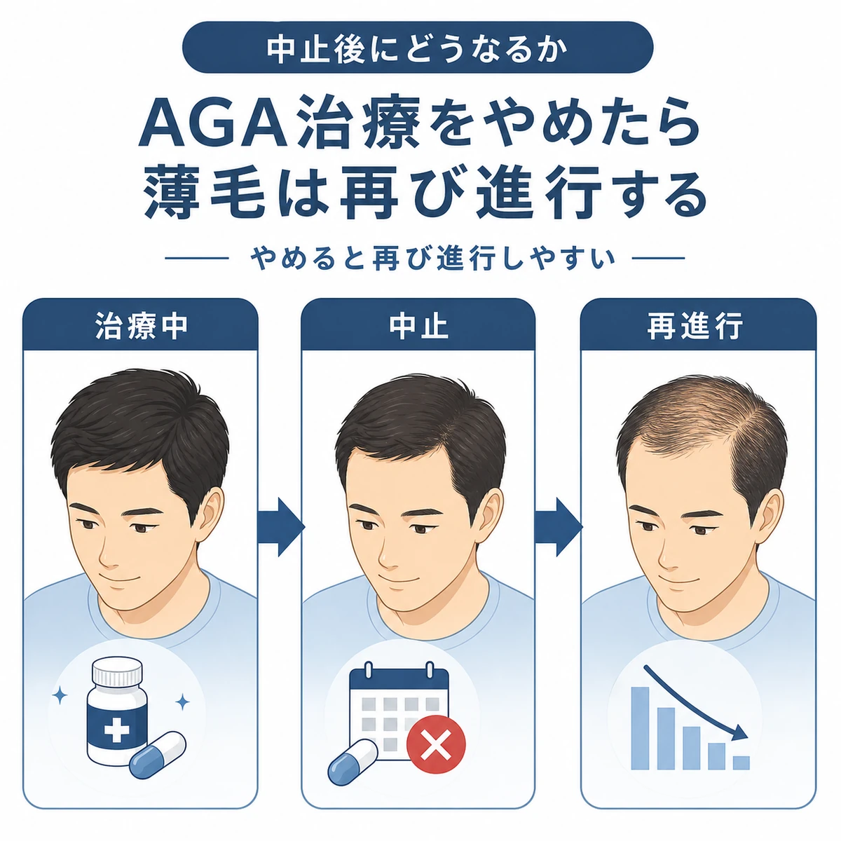 AGA治療をやめると薄毛が再び進行していく流れを段階的に表した医療イラスト