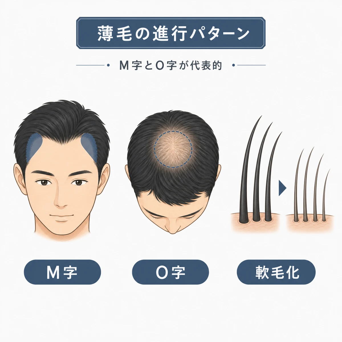 M字型とO字型と軟毛化という遺伝性AGAの代表的な薄毛パターンを並べて比較した医療イラスト