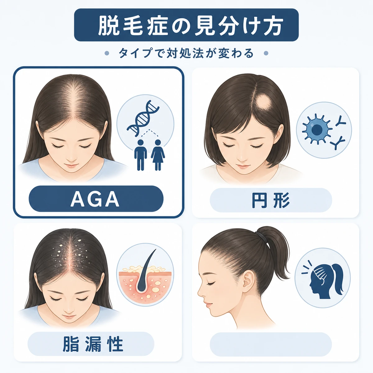 AGAと円形脱毛症や脂漏性脱毛症など他の脱毛症の特徴を比較した医療イラスト