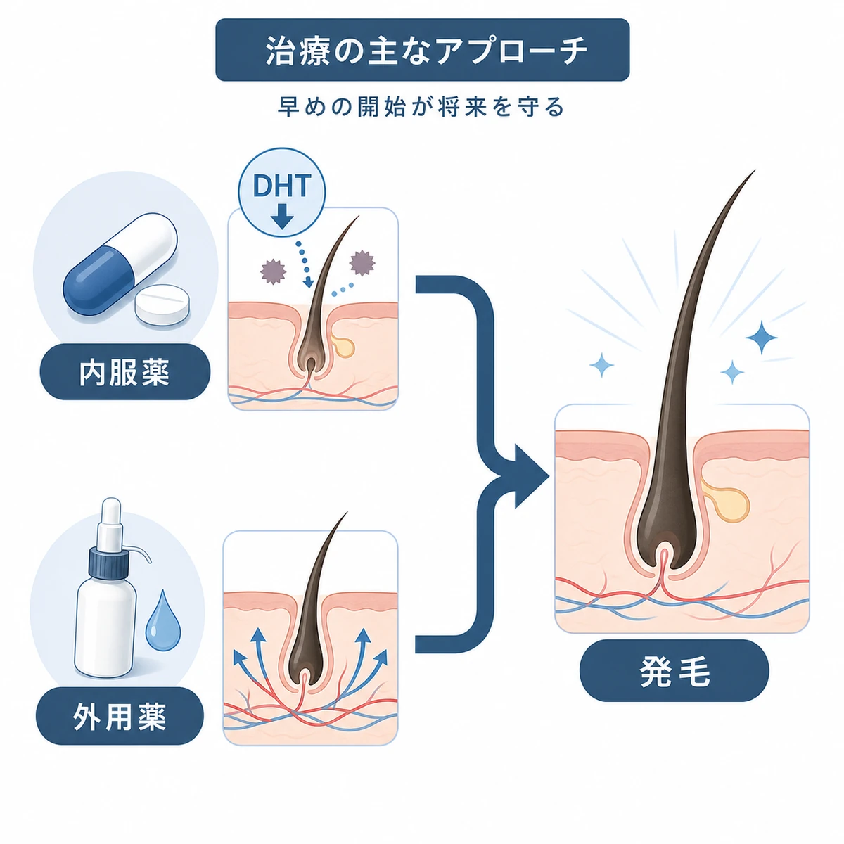 内服薬と外用薬がDHT抑制と血行促進を通じて発毛を後押しするAGA治療の仕組みを表した医療イラスト