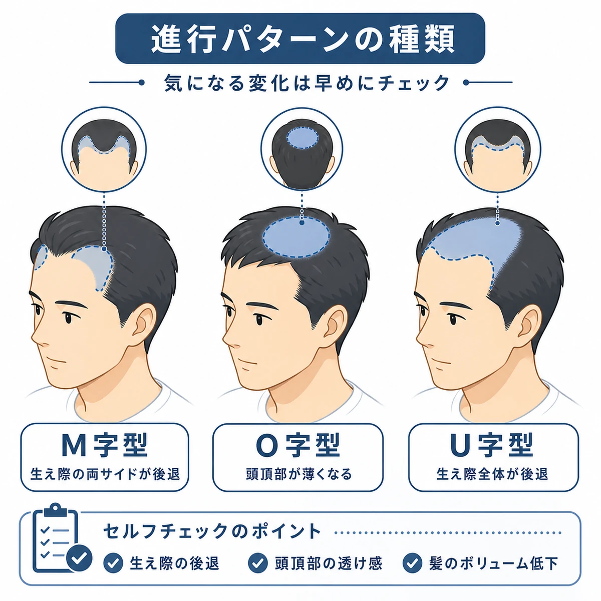 M字型・O字型・U字型という薄毛の進み方を並べて比較した医療イラスト