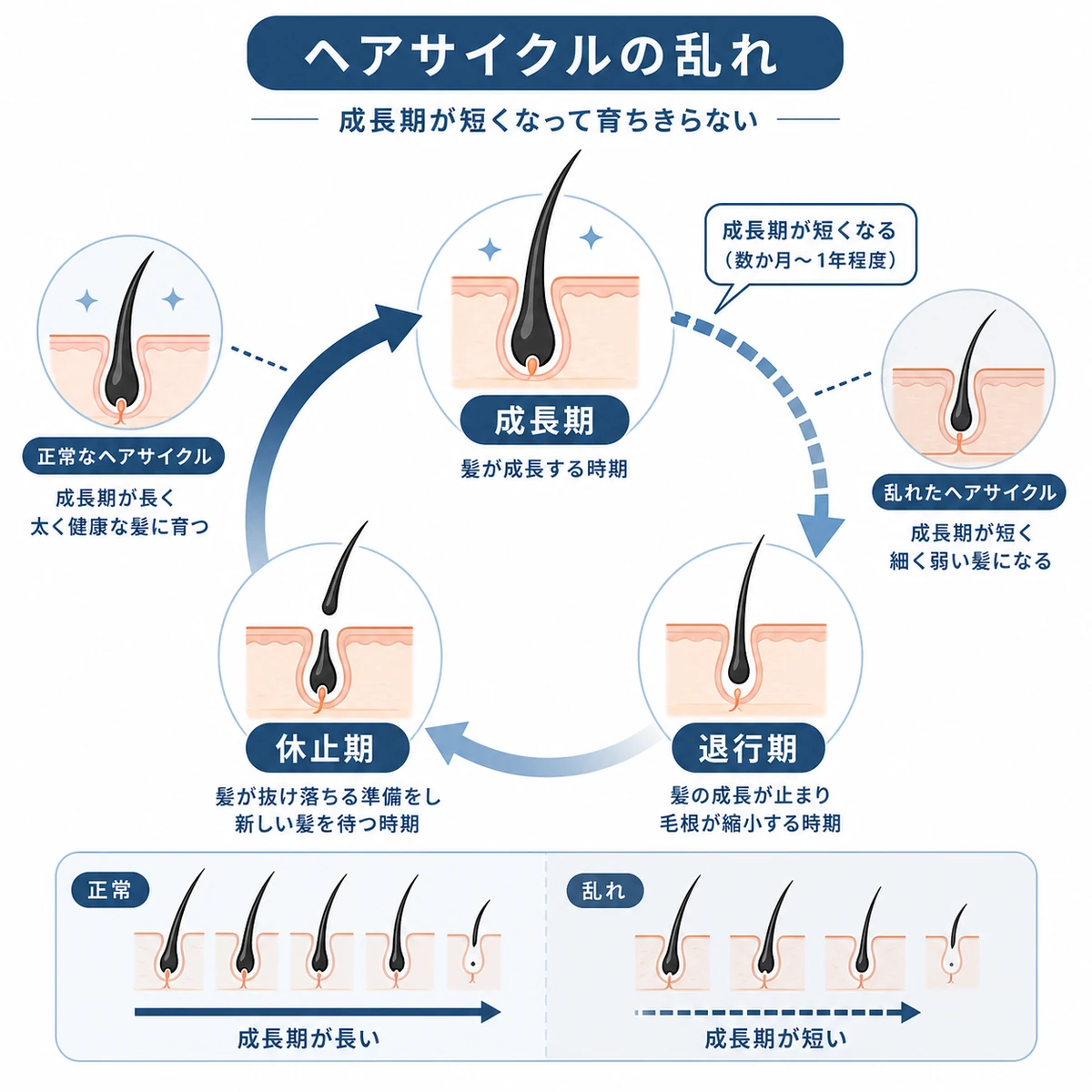 成長期・退行期・休止期の毛周期が乱れて薄毛につながる仕組みを表した医療イラスト