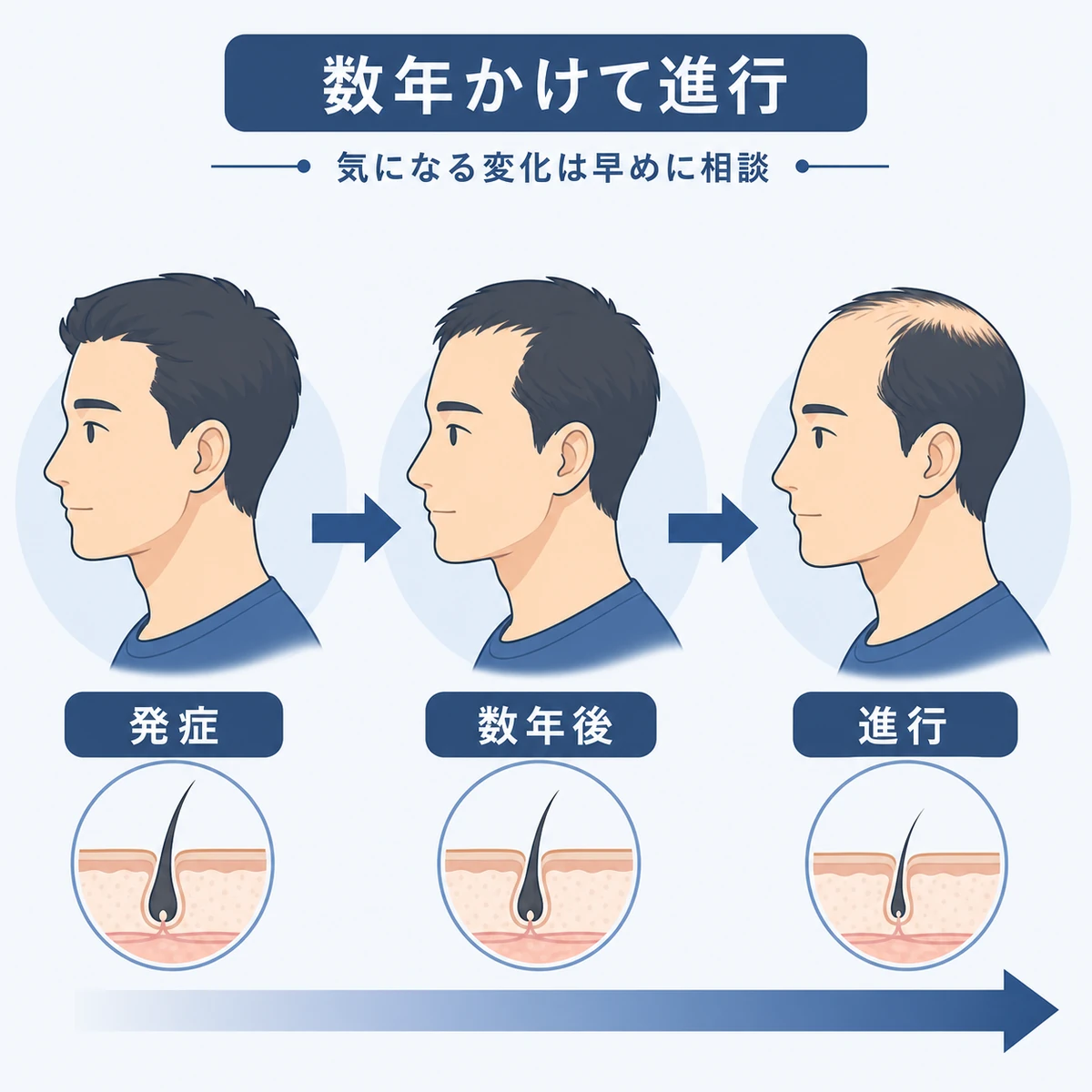 AGAが数年かけて段階的に進行していく様子を表した医療イラスト