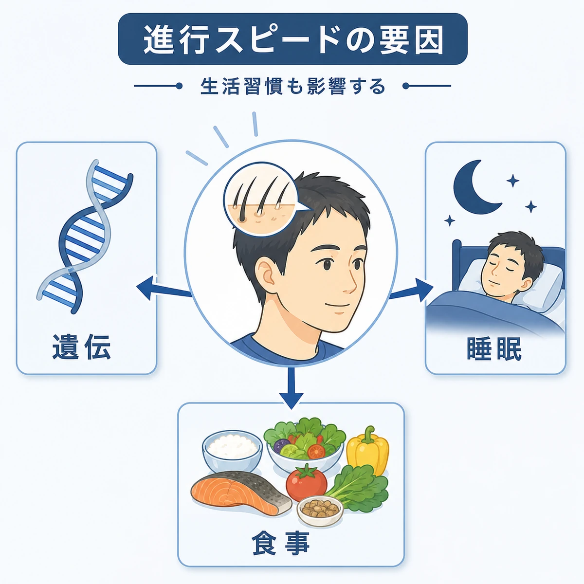 AGAの進行スピードに関わる遺伝や生活習慣の要因を表した医療イラスト