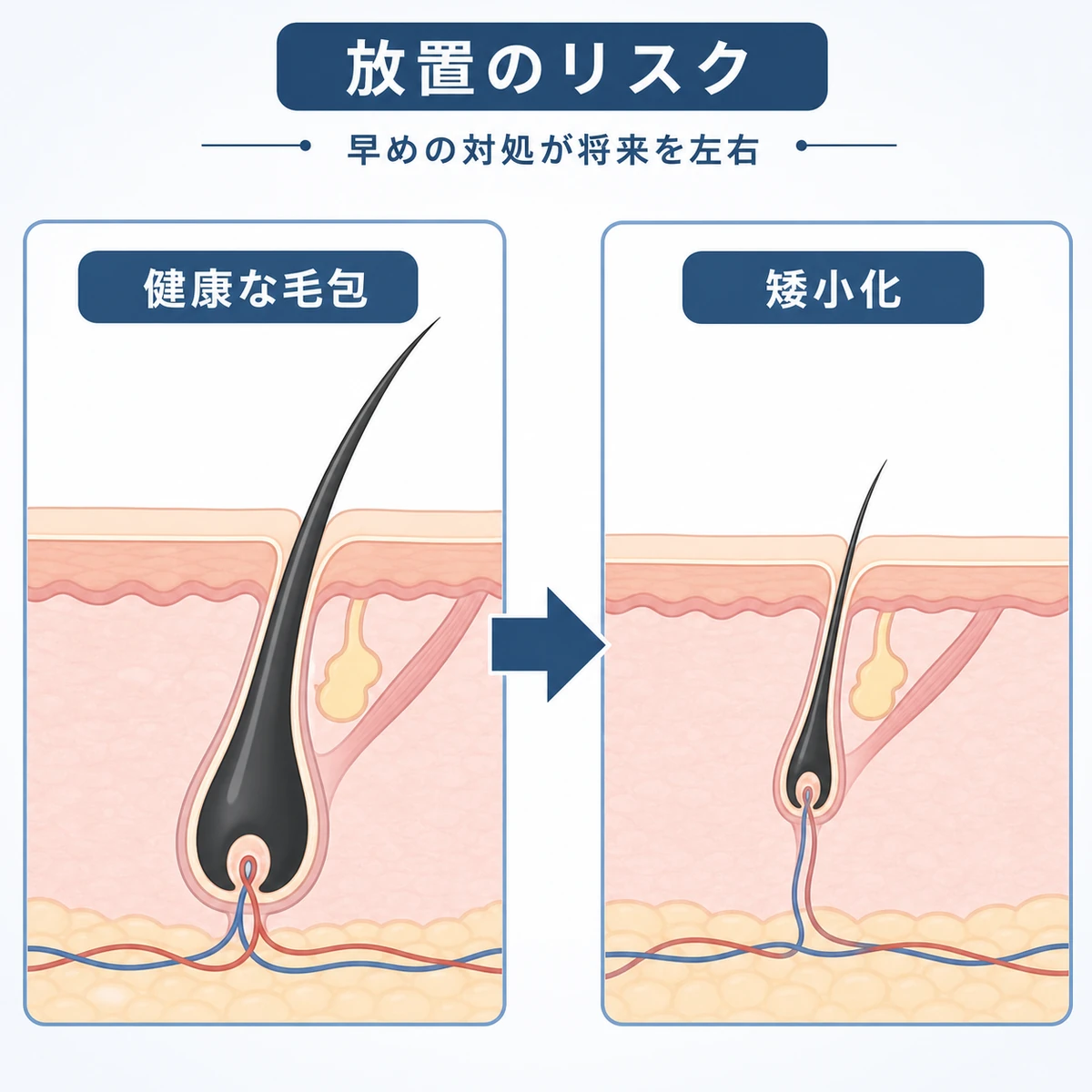 健康な毛包と矮小化した毛包を比べたAGAの医療イラスト