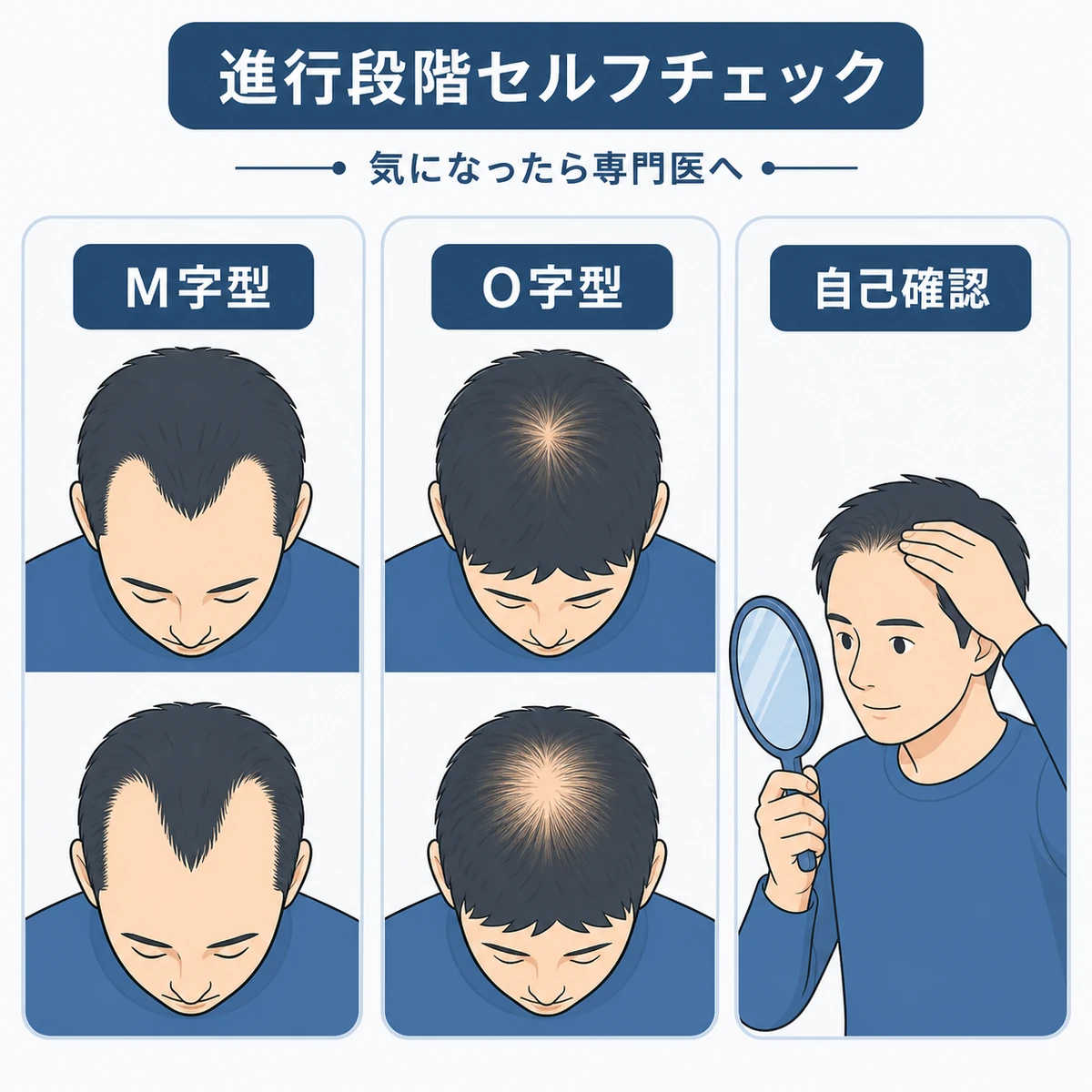M字型やO字型などAGAの進行段階をセルフチェックする医療イラスト