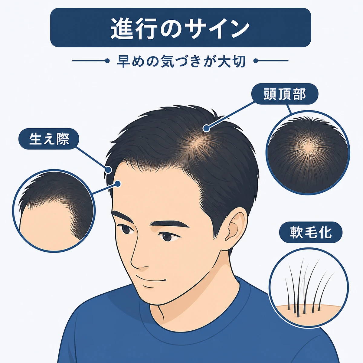 生え際の後退や頭頂部の薄毛などAGA進行のサインを描いた医療イラスト