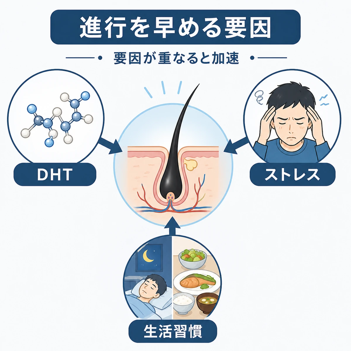 DHTやストレスなどAGAの進行を早める要因を毛根を中心に表した医療イラスト