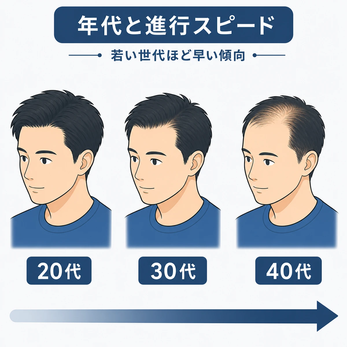 20代から40代までの年代別にAGAの進行スピードの違いを比べた医療イラスト