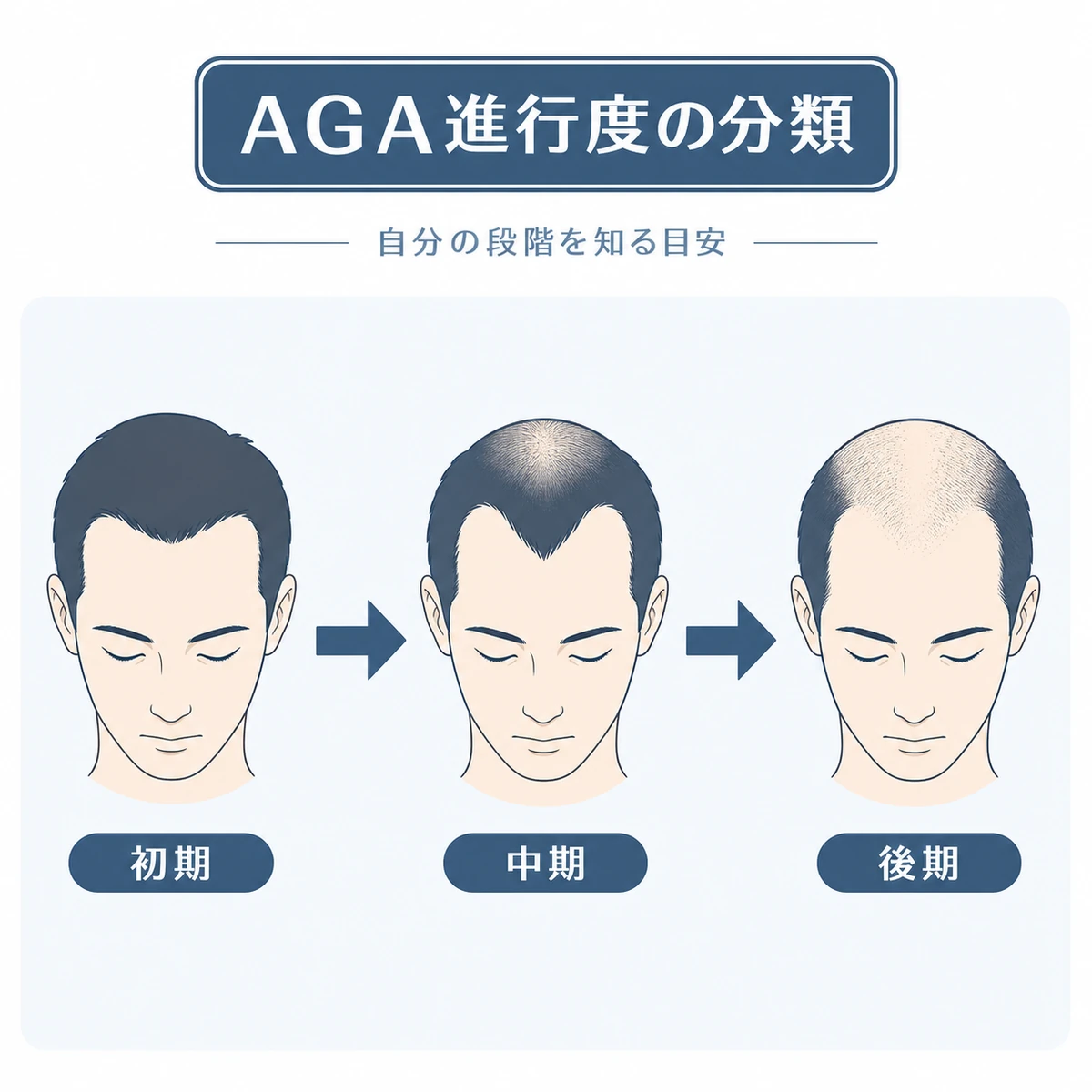 ハミルトン・ノーウッド分類によるAGA進行度の段階を示した医療イラスト