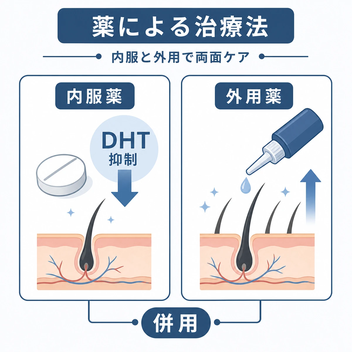 内服薬と外用薬によるAGA治療法の違いを対比した医療イラスト